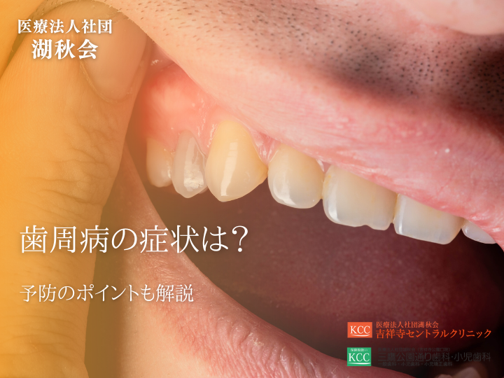 歯周病の症状は？予防のポイントも解説