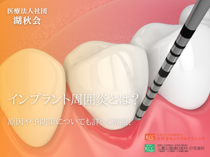 インプラント周囲炎とは？原因や予防策についても詳しく解説！