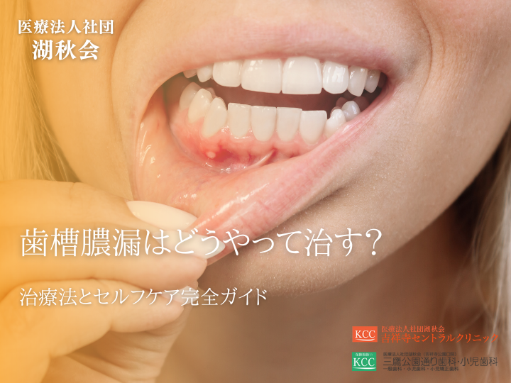 歯槽膿漏はどうやって治す？治療法とセルフケア完全ガイド