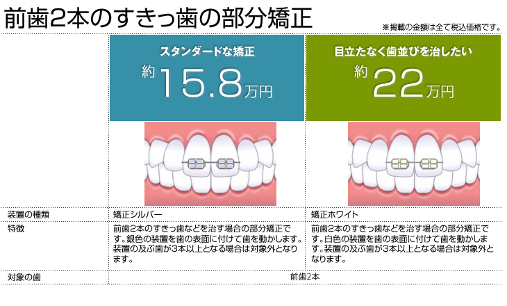 前歯2本のすきっ歯の部分矯正