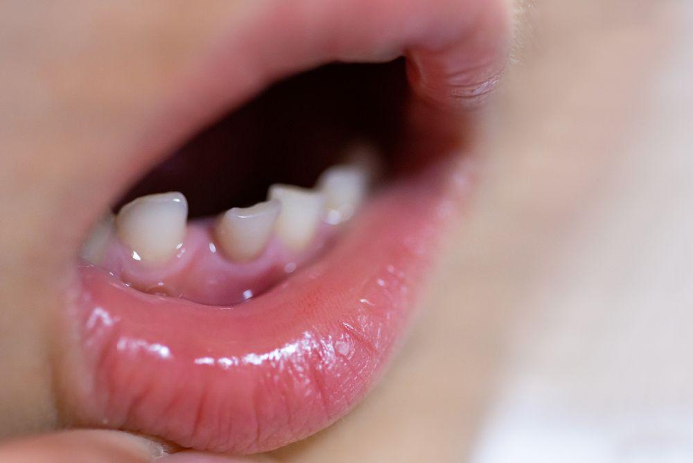 子どもの歯並びが悪い場合｜放置のリスクと歯並びを悪化させないためのポイントを解説
