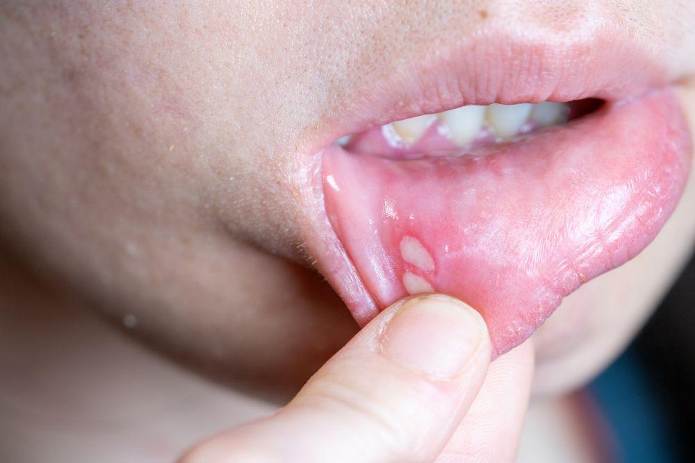 矯正中は口内炎ができやすい！原因やできた場合の対処法、予防法を解説