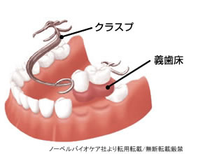 保険の部分入れ歯