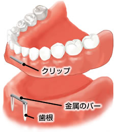 バーと連結させる入れ歯治療
