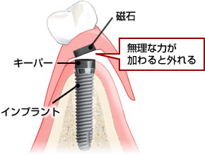 磁石アタッチメントデンチャー(インプラント)