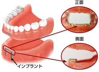 バーと連結させる入れ歯治療