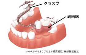 部分入れ歯