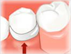 白いクラスプを使用した部分入れ歯