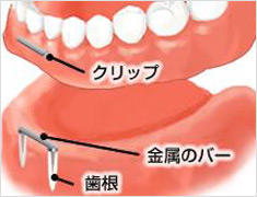 アタッチメント