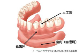 部分入れ歯