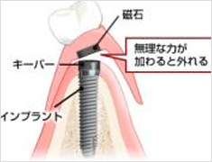 インプラント併用
