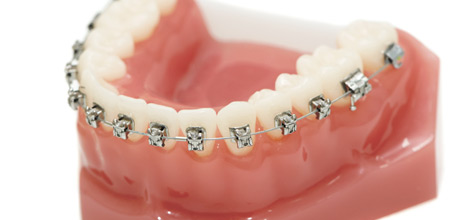 矯正歯科…歯並び、かみ合わせの調節