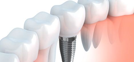 インプラント治療…インプラントを併用する義歯治療
