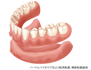 総入れ歯治療