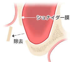 歯肉を剥離し、ピエゾサージェリーで骨を取り除く