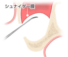 シュナイダー膜を持ち上げ隙間を作る