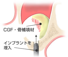 フィブリンゲルとインプラントの埋入