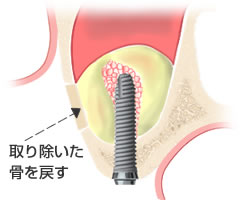 骨を元に戻す