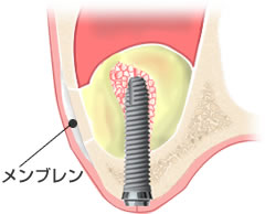 フィブリンゲルをつぶしメンブレンとして使用