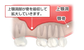 歯が抜けてしまった上顎