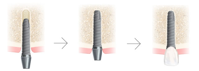 インプラントの埋入