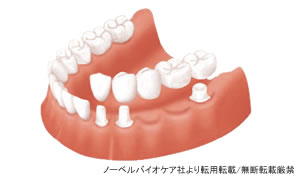 ブリッジ治療