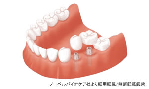 インプラント治療