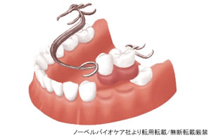 入れ歯治療