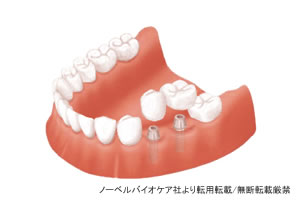 インプラント治療