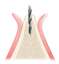 歯槽骨に穴を掘る
