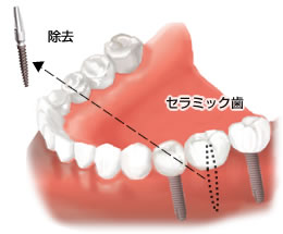 フィブリンゲルとインプラントの埋入