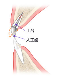 セラミッククラウンによる改善例