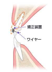 一般的な唇側矯正（表側矯正）による改善例