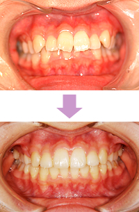矯正治療前後