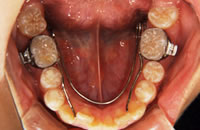 拡大床装置／下顎