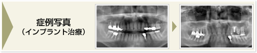 症例写真（インプラント治療）