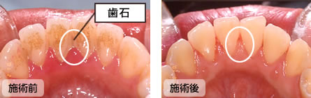 歯の裏側に歯石が付着し、歯肉が見えなくなっていました