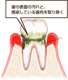 歯周ポケット掻爬術