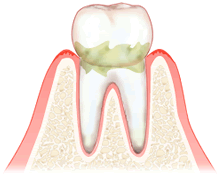 軽度（歯肉炎）