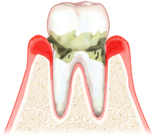 中度（歯周炎）