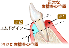 エムドゲイン組織再生療法