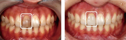セラミッククラウン治療