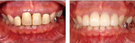 メタルボンドセラミッククラウン治療例