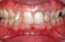 治療前／変色歯・ブラックマージン・歯の歪み