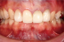治療後／変色歯・ブラックマージン・歯の歪み