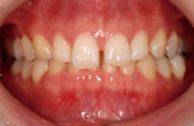 治療前／歯の隙間