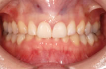 治療後／歯の隙間
