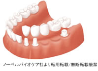 セラミックブリッジ治療