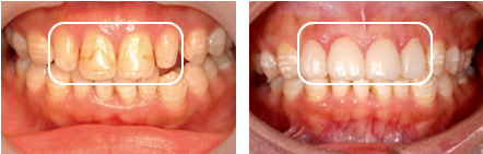 ラミネートベニア治療例