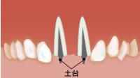 セラミック歯の土台挿入